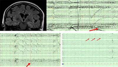 Recurrent Epileptic Auras As a Presenting Symptom of Alzheimer’s Disease